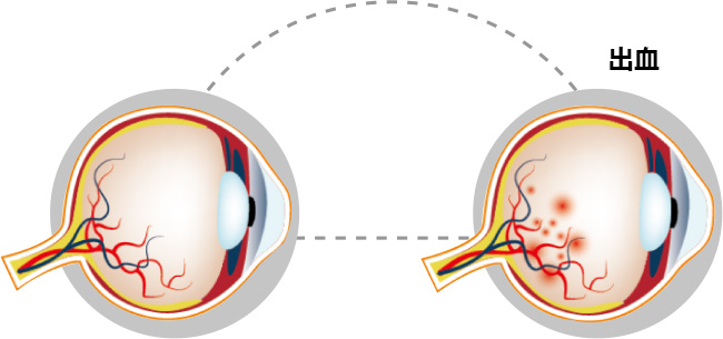 眼底出血